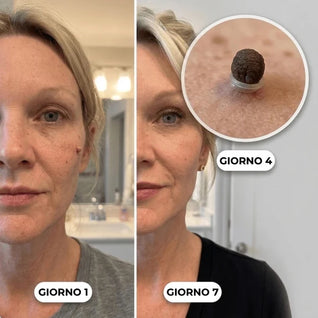 Kit di Rimozione dei Fibromi Penduli