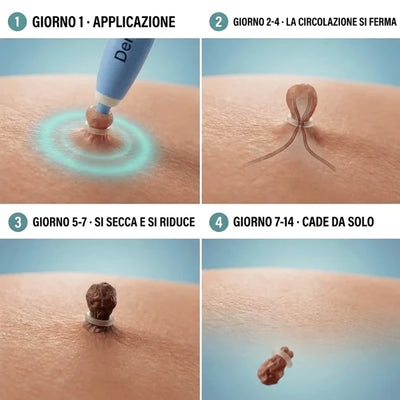 Kit di Rimozione dei Fibromi Penduli